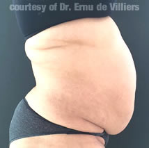 VaserLipoSculpt28Before