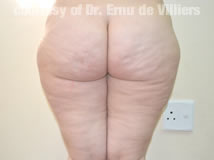 VaserLipoSculpt29Before