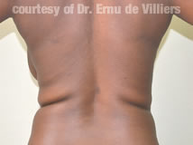 VaserLipoSculpt30Before