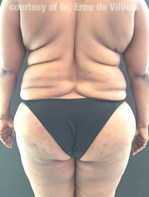 VaserLipoSculpt38Before