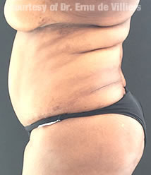 VaserLipoSculpt39Before