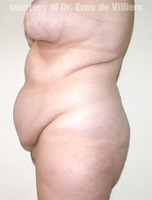 VaserLipoSculpt40Before