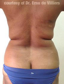 VaserLipoSculpt41Before