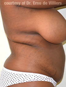 VaserLipoSculpt42Before