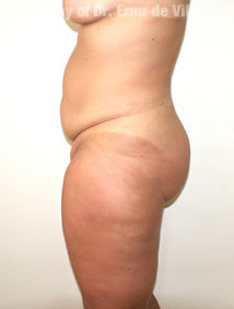 VaserLipoSculpt44Before