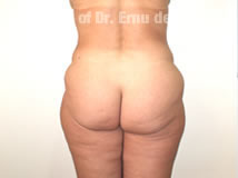 VaserLipoSculpt45Before