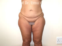 VaserLipoSculpt46Before