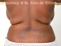 VaserLipoSculpt47Before