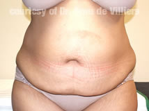 VaserLipoSculpt37After