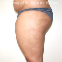 VaserLipoSculpt19Before