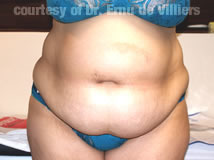 VaserLipoSculpt37Before