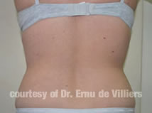 VaserLipoSculpt01After