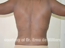 VaserLipoSculpt03After