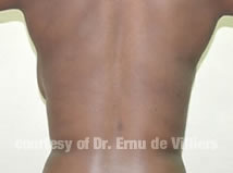 VaserLipoSculpt04After