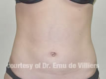 VaserLipoSculpt10After