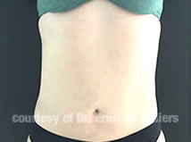 VaserLipoSculpt11After