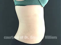 VaserLipoSculpt12After