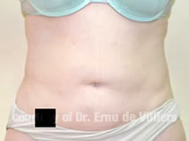 VaserLipoSculpt14After