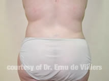 VaserLipoSculpt15After