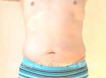 VaserLipoSculpt18After