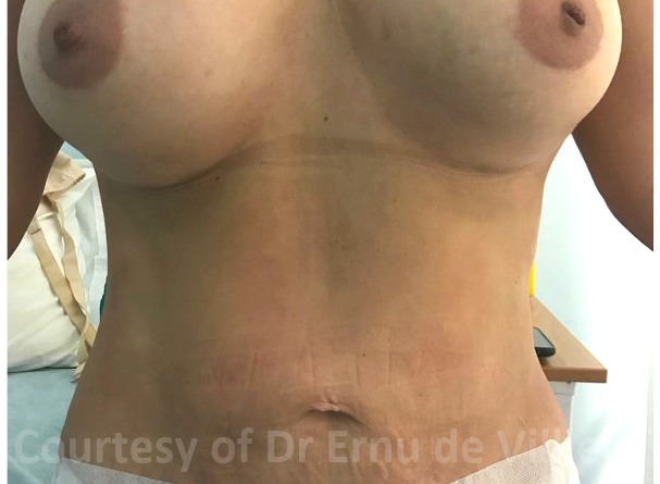 VaserLipoSculpt21After