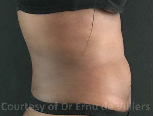 VaserLipoSculpt24After