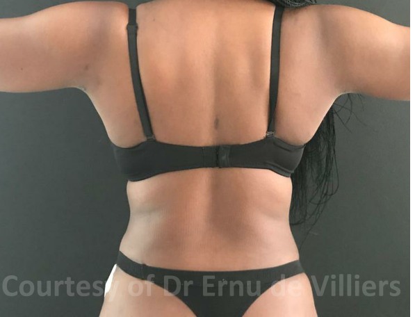 VaserLipoSculpt25After