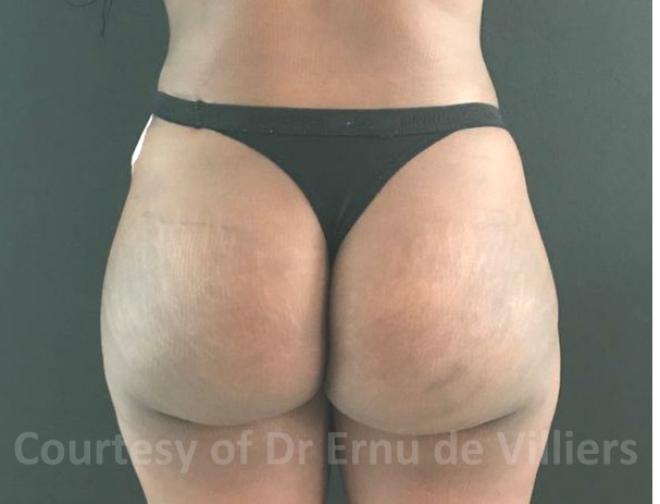 VaserLipoSculpt26After