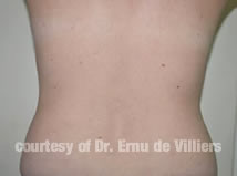 VaserLipoSculpt01Before