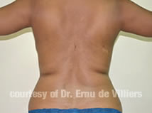 VaserLipoSculpt03Before