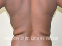 VaserLipoSculpt04Before