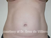 VaserLipoSculpt10Before