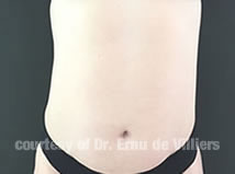 VaserLipoSculpt11Before