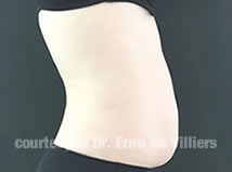 VaserLipoSculpt12Before