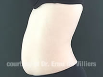 VaserLipoSculpt13Before