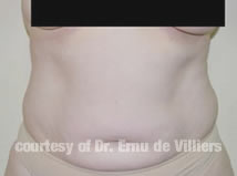 VaserLipoSculpt14Before