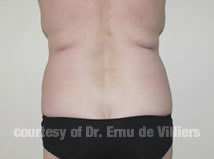 VaserLipoSculpt16Before