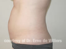 VaserLipoSculpt17Before