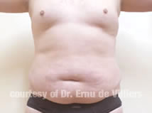 VaserLipoSculpt18Before