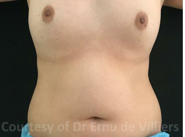 VaserLipoSculpt22Before