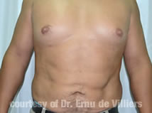 VaserLipoSculpt05After