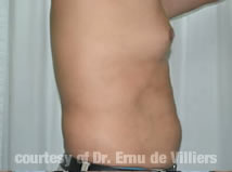 VaserLipoSculpt05After