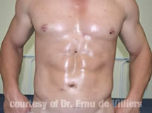 VaserLipoSculpt05After