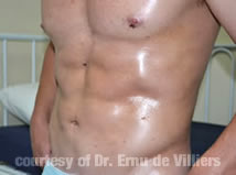 VaserLipoSculpt05After