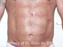 VaserLipoSculpt05After