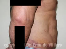 VaserLipoSculpt05After