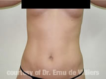 VaserLipoSculpt03Before