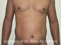 VaserLipoSculpt04Before