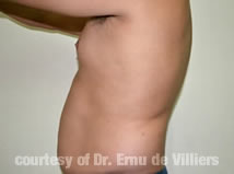 VaserLipoSculpt05Before