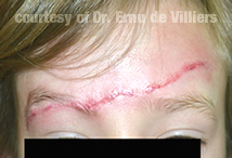 MicroNeedling03Before